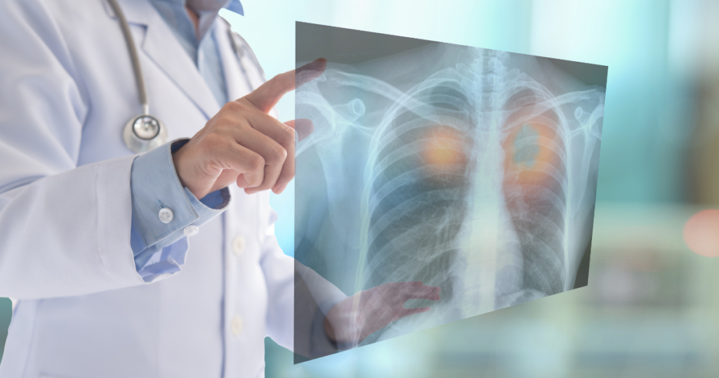 Low lung cancer screening rates show an opportunity to save lives