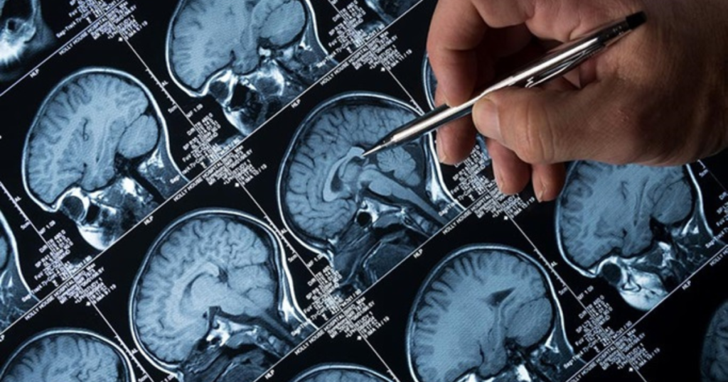 New treatment options for people with drug-resistant epilepsy