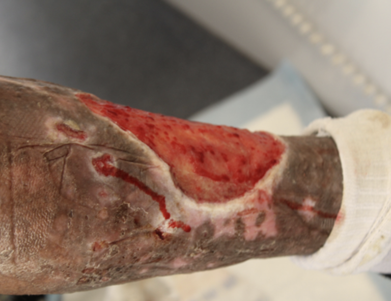 Gilbert Ramirez’s wound during cleaning and treatment at the Los Angeles Inn in Inglewood. Photo by Marion Apio